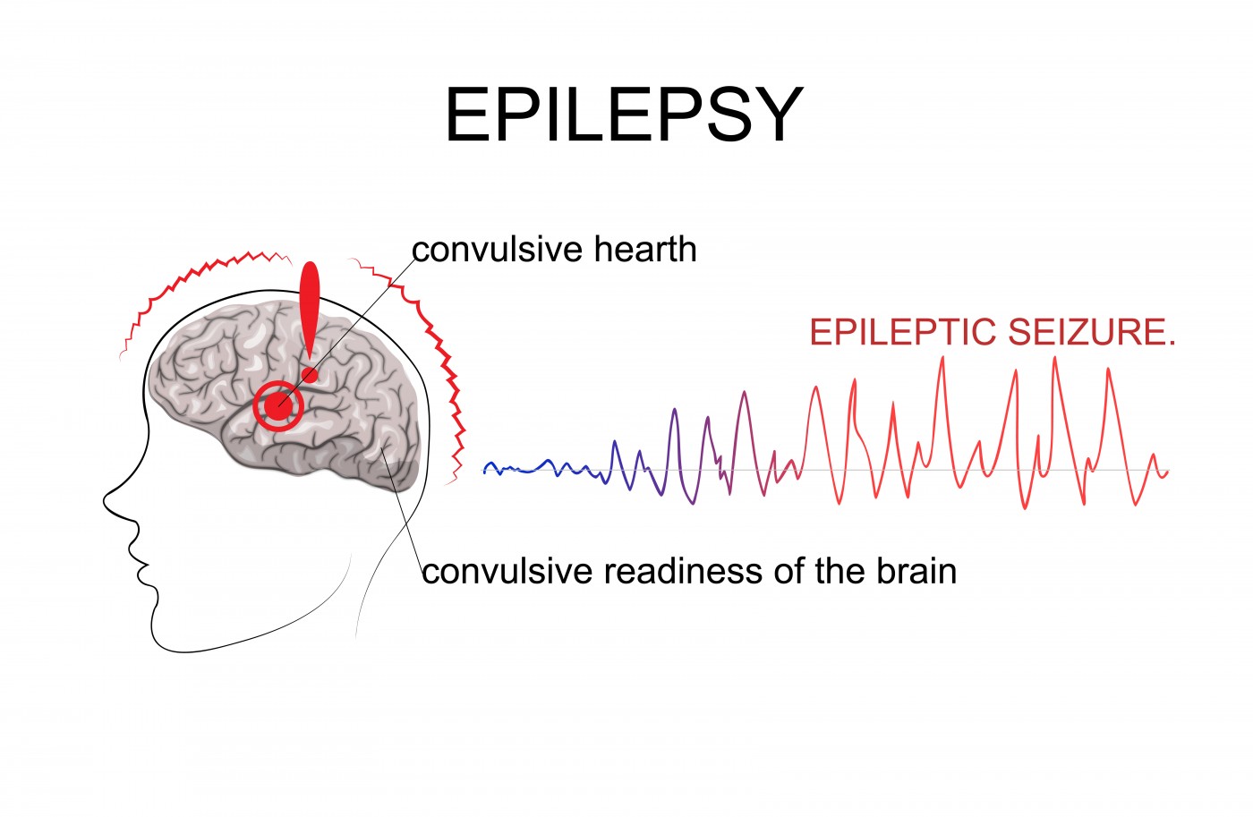 epilepsy seizure disorder