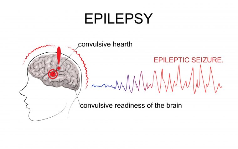 epileptic seizure prediction