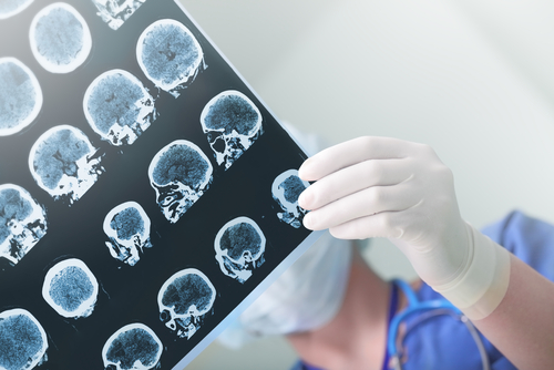 Dystrophin Levels Unusually High in Temporal Lobe Epilepsy Patients, Study Reports