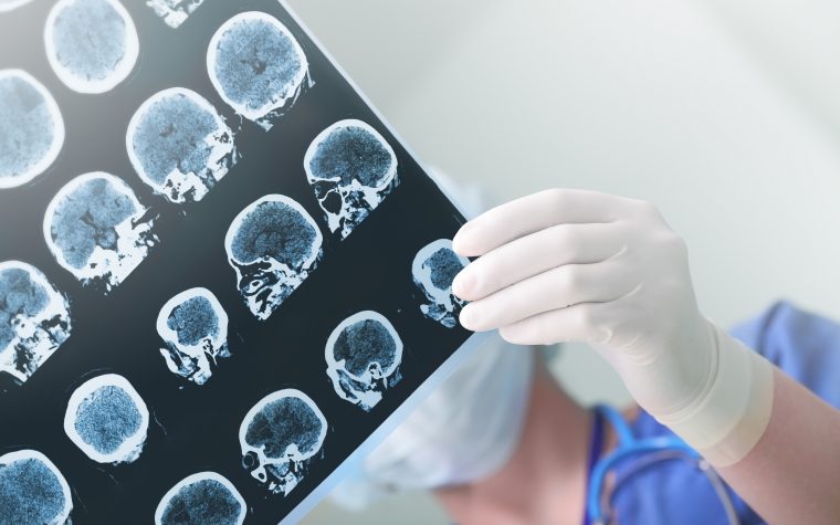 right-sided temporal lobe epilepsy