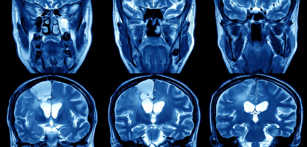 Stimulation of Brain Regulatory System Improves Seizures, Guinea Pig Study Shows