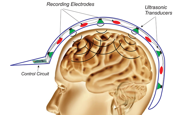 Researchers Working on Non-Invasive Method to Suppress Epileptic Seizures